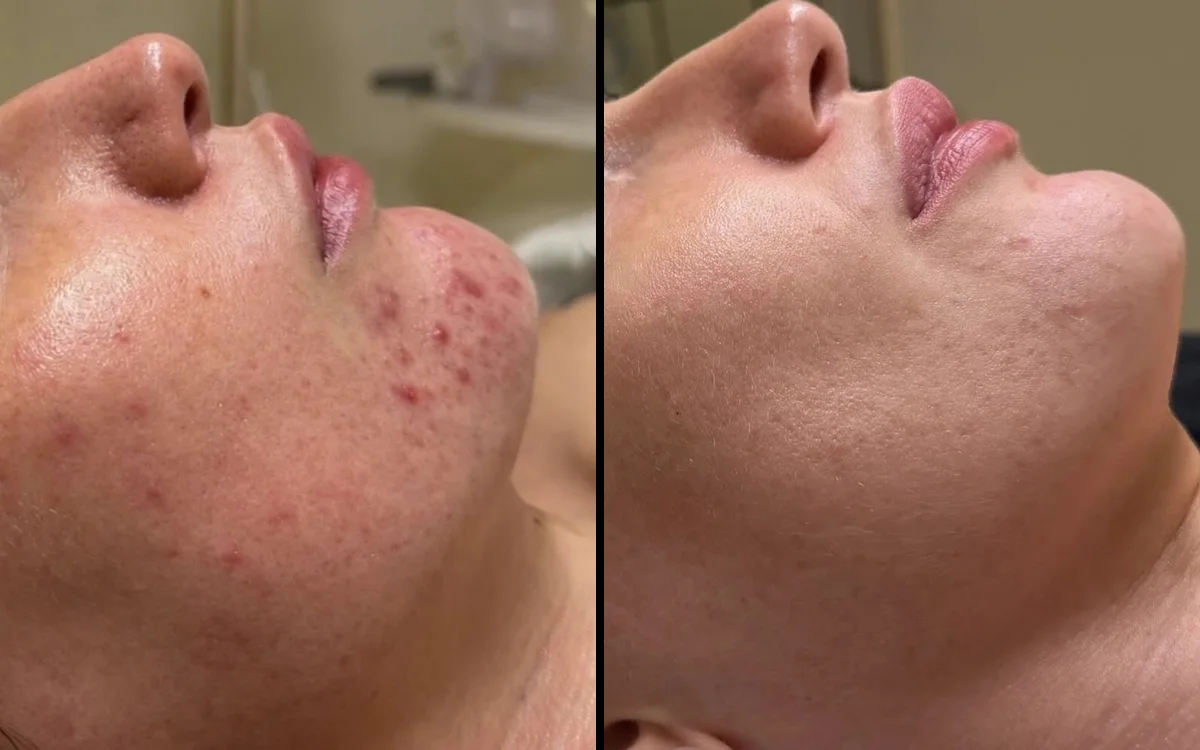 Acne + inflammation: before and after, Week 0 → Week 12