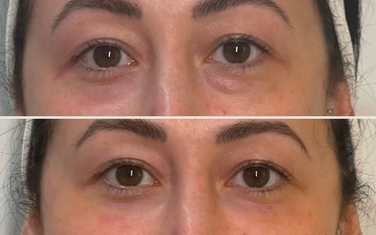 Under-eye hollows + dullness: before and after, Week 0 → Week 12