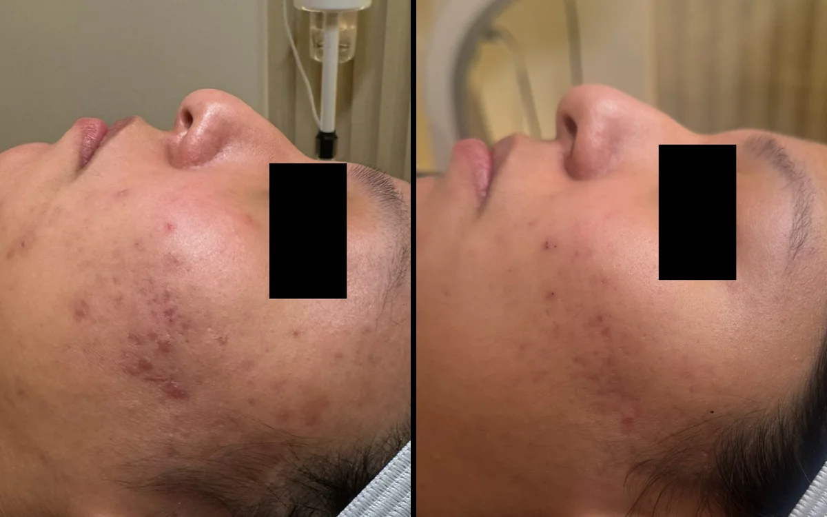 Acne + post-acne pigmentation: before and after, Week 0 → Week 12