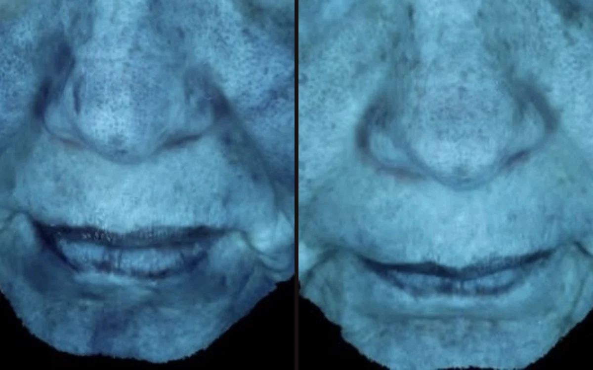 Pigmentation + UV spots: before and after, Week 0 → Week 20