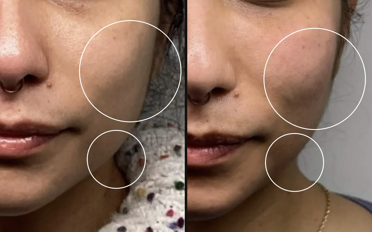 Mid-face volume loss + shadowing: before and after, Week 0 → Week 20