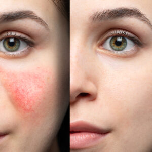 Sculptra for Cheeks, Temples, and Jawline: Treatment Mapping & Timeline