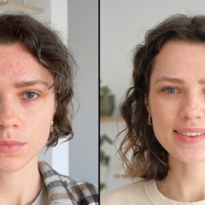 Sculptra for Cheeks, Temples, and Jawline: Treatment Mapping & Timeline