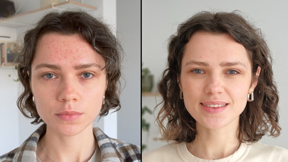 Which VI Peel Is Right for You? Original vs. Precision Plus vs. Advanced