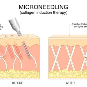 Hydrafacial: What It Does (and Doesn’t) Do for Blackheads, Texture, and Glow