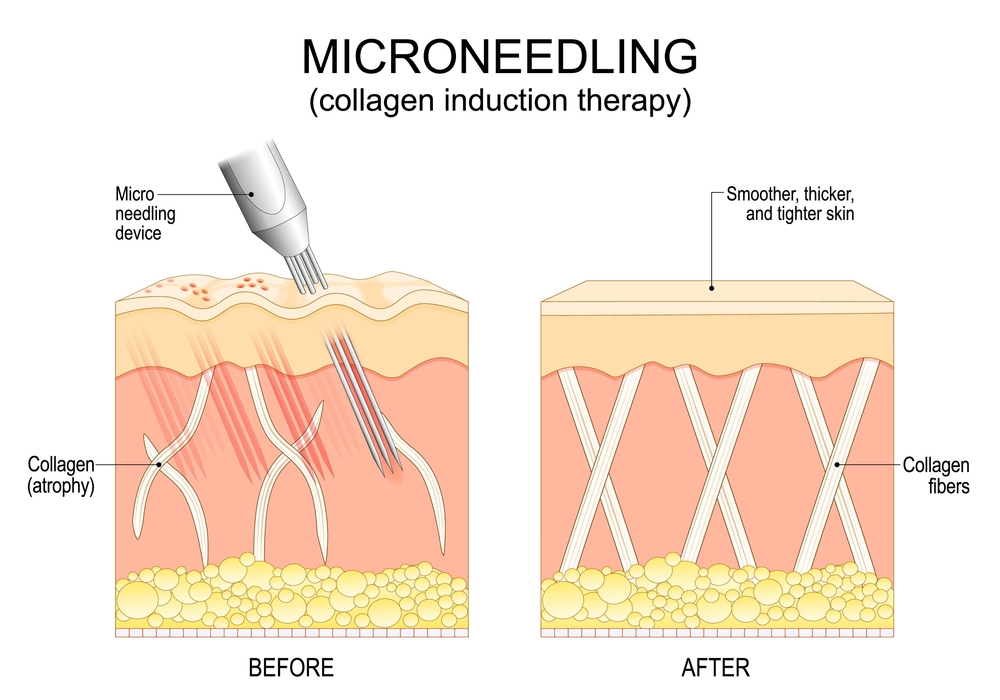 Cost & Value: Is PRF Microneedling Worth It for Acne Scars?