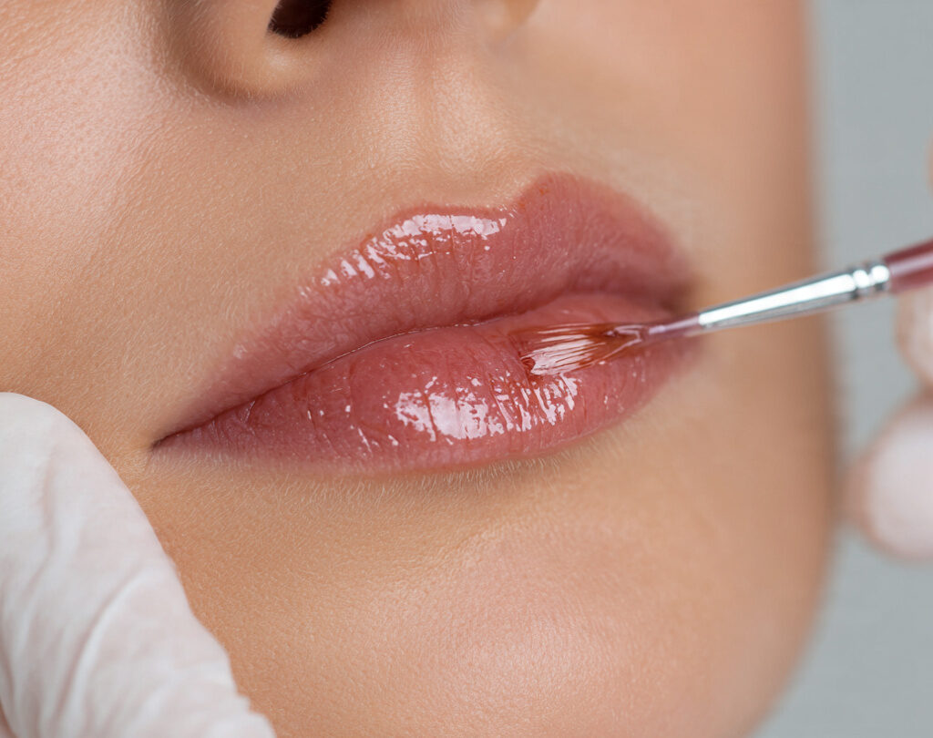 Chemical Peel for Lips: Benefits, Process, Recovery, Results & Where to Get It Done Safely