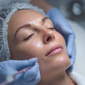 Chemical Peel for Pigmentation